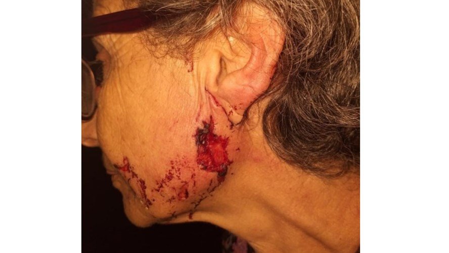 Una mujer fue atacada por los pitbull de su vecino y le arrancaron parte de la oreja