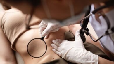 Melanoma. Advierten nuevos casos de melanoma.