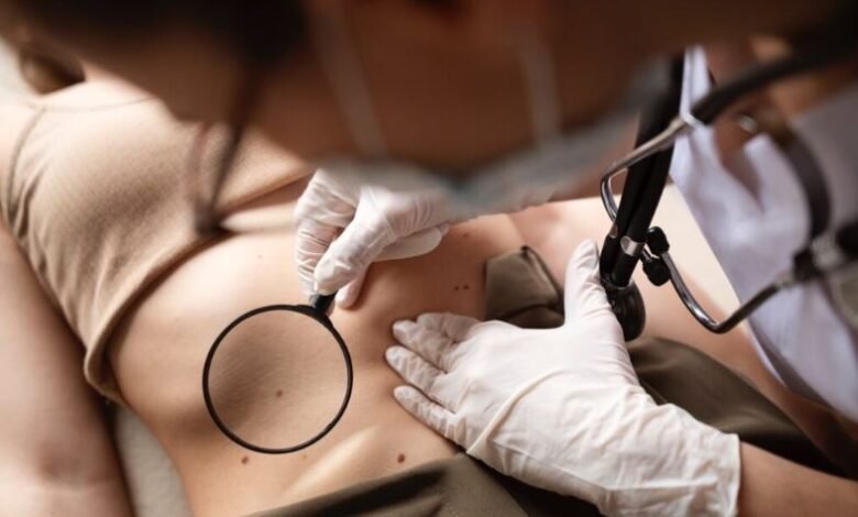 Melanoma. Advierten nuevos casos de melanoma.