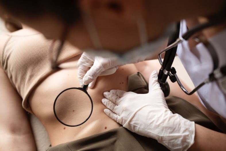 Melanoma. Advierten nuevos casos de melanoma.
