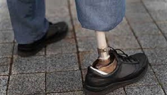 Cirugía. Una cirugía transformó el uso de prótesis.