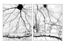 Estudio. Claves para mejorar las terapias contra el Parkinson.