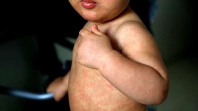 Sarampión. La OPS emitió una alerta epidemiológica.