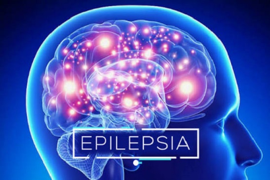 La epilepsia y las barreras que enfrentan miles de pacientes.