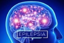 Epilepsia: los avances en los tratamientos conviven con barreras.