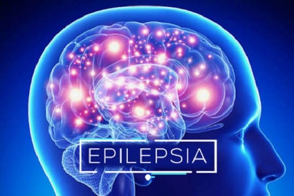 Epilepsia: los avances en los tratamientos conviven con barreras.